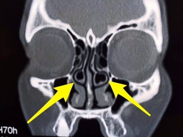 Xoang hơi cuốn mũi [58 cases]