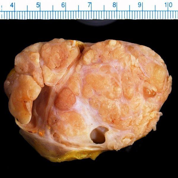 Bướu diệp thể [32 cases]