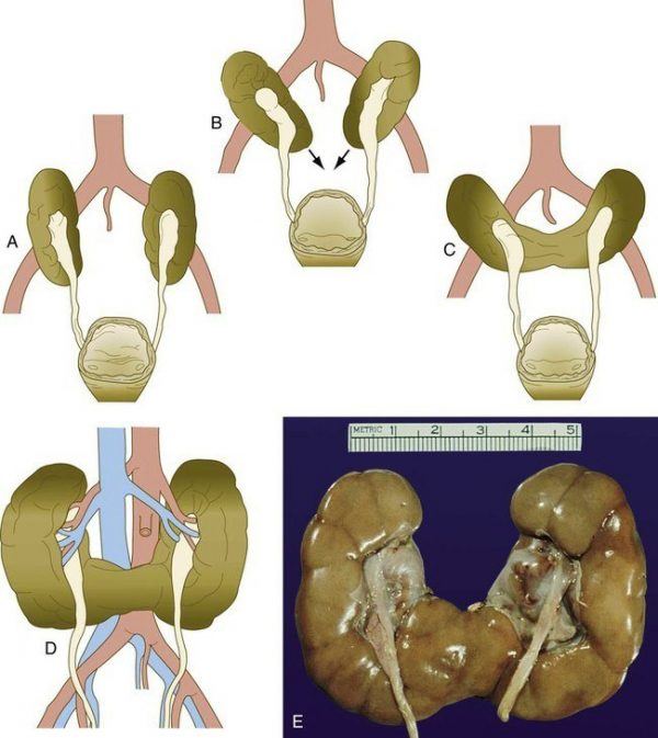 Thận móng ngựa [88 cases]