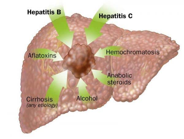 HCC [324 cases]