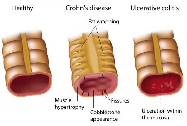 Crohn [62 cases]