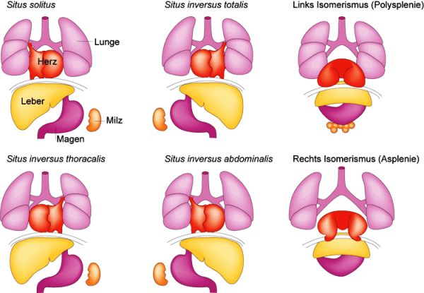 Đảo ngược phủ tạng [51 cases]