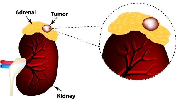 U tuyến thượng thận [105 cases]