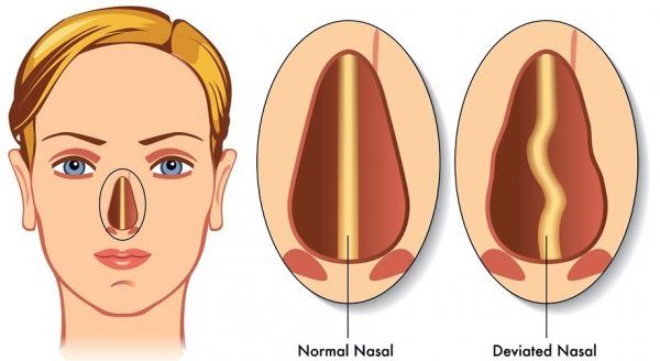 Vẹo vách ngăn [41 cases]