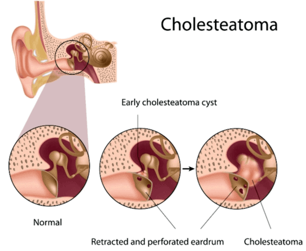 Cholesteatoma [64 cases]