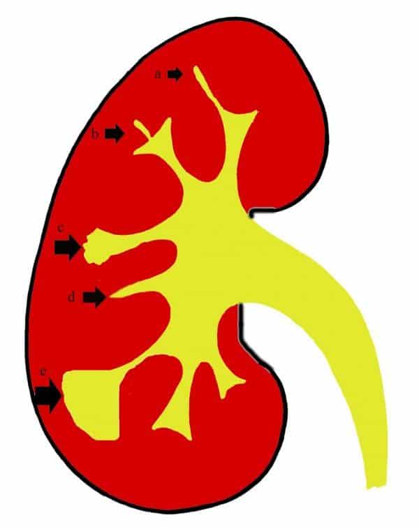 Lao hệ tiết niệu [70 cases]