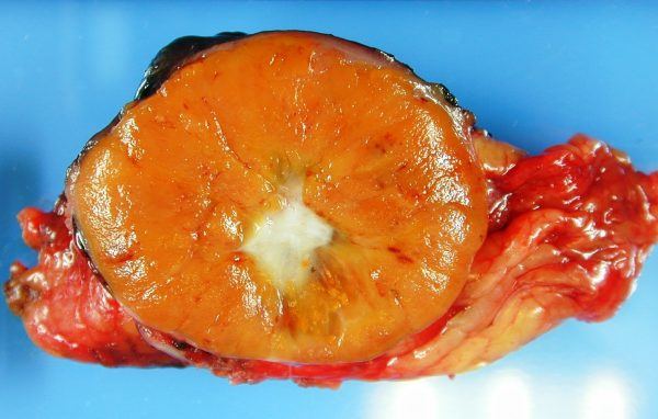U tế bào lớn ưa toan [35 cases]