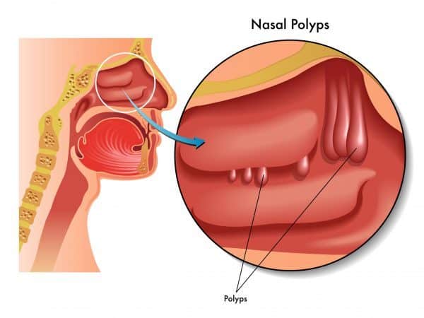 Polyp mũi xoang [56 cases]