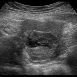 Ung thư buồng trứng