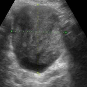 Ung thư buồng trứng