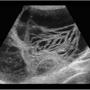 Ung thư buồng trứng