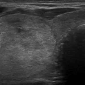 U tuyến tuyến giáp