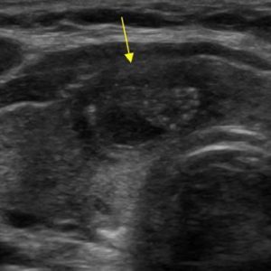 Nang keo tuyến giáp