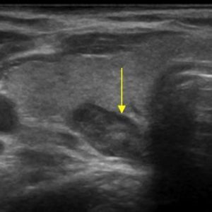 U tuyến cận giáp