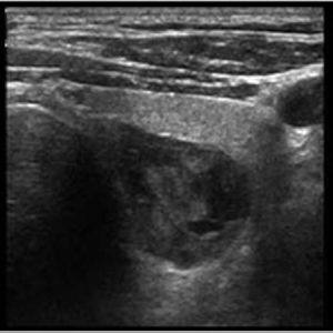 U tuyến cận giáp