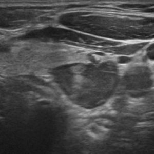 U tuyến cận giáp