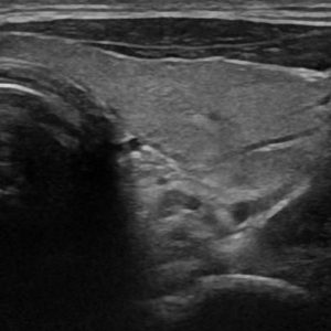 U tuyến cận giáp