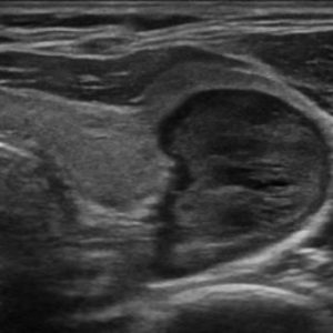 U tuyến cận giáp