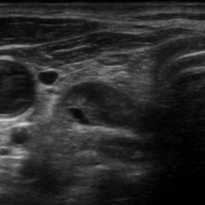 U tuyến cận giáp