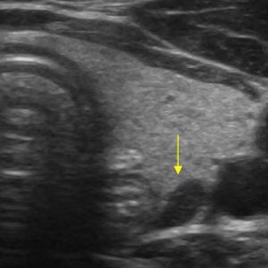 U tuyến cận giáp