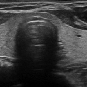 U tuyến cận giáp