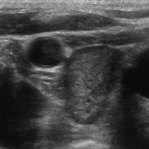 U tuyến cận giáp