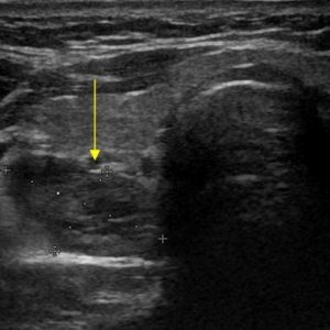 U tuyến cận giáp