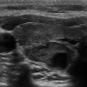 U tuyến cận giáp