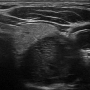 U tuyến cận giáp