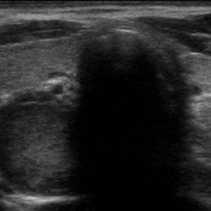 U tuyến cận giáp