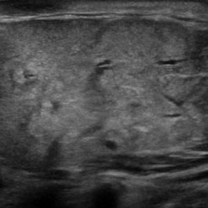 Sỏi tuyến nước bọt