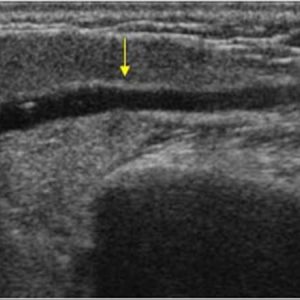 Sỏi tuyến nước bọt