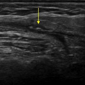 Sỏi tuyến nước bọt
