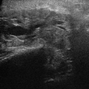 Sỏi tuyến nước bọt