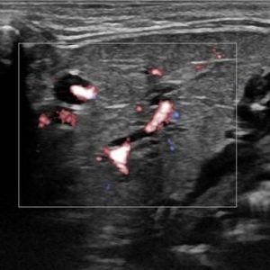 Sỏi tuyến nước bọt