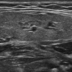 Sỏi tuyến nước bọt