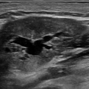 Sỏi tuyến nước bọt