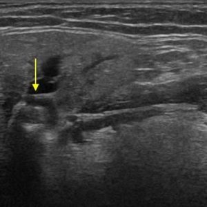 Sỏi tuyến nước bọt