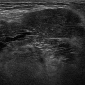 Sỏi tuyến nước bọt