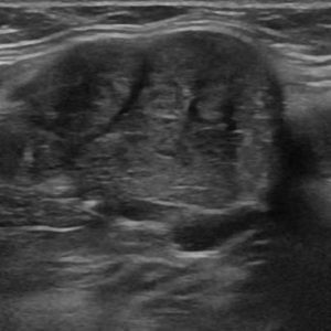 Sỏi tuyến nước bọt