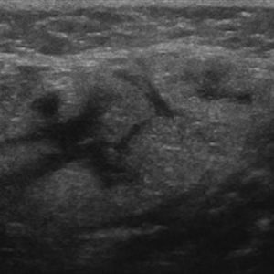 Sỏi tuyến nước bọt