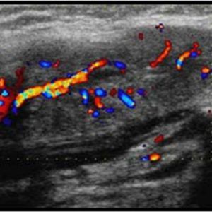 Sỏi tuyến nước bọt