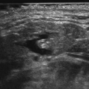 Sỏi tuyến nước bọt