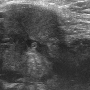 Sỏi tuyến nước bọt