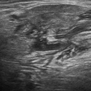 Sỏi tuyến nước bọt