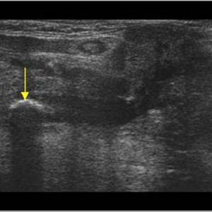 Sỏi tuyến nước bọt
