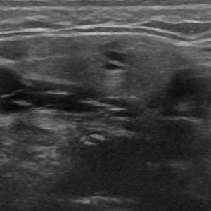 Sỏi tuyến nước bọt