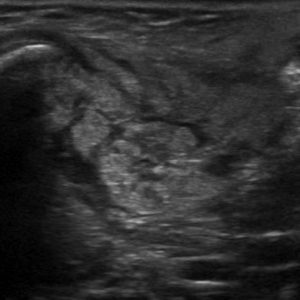 Viêm tuyến nước bọt