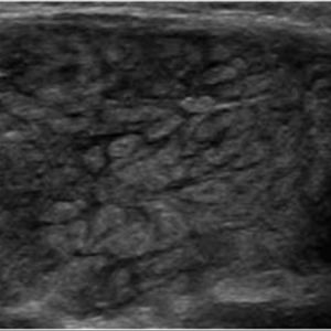 Viêm tuyến nước bọt