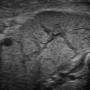 Viêm tuyến nước bọt